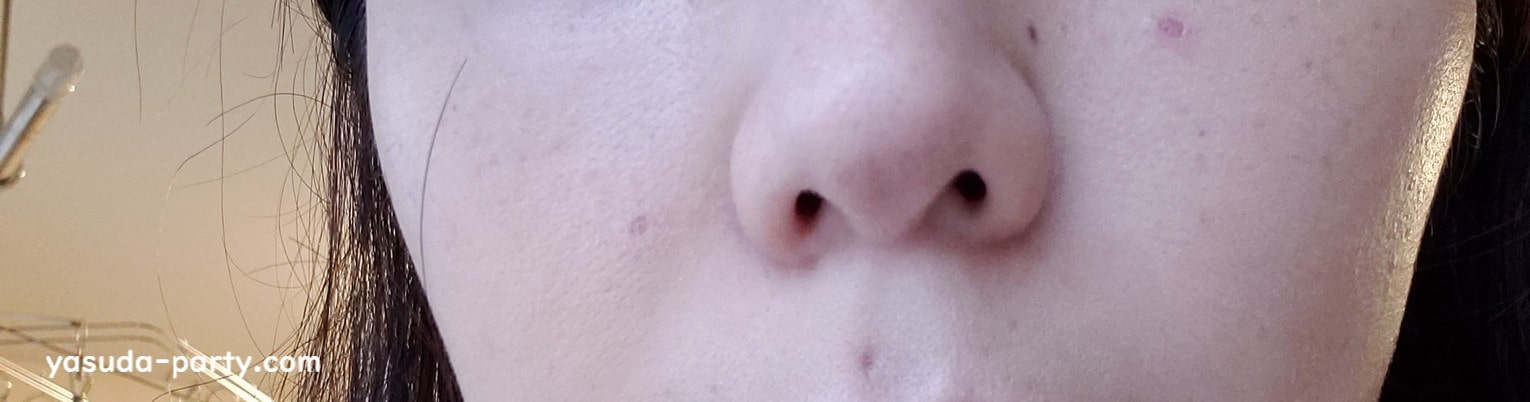 ほくろを除去して1か月経ちましたレポ 費用や経過など やす田パーティー